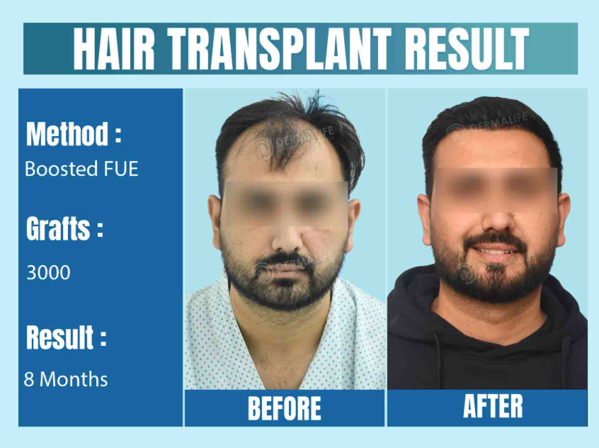 Hair Transplant Myths vs Reality in India (2025): The Reality Behind Boosted FUE